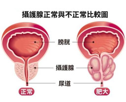 攝護腺增生會影響性能力